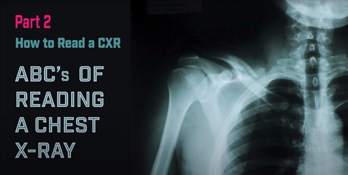 ABCs Of Reading A Chest X-Ray – How To Read A Chest X-Ray (Part 2)